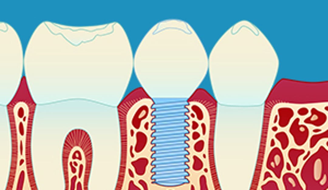 Implantat_enkel_thumbnail_w300__c119e95483413dad59589c36bf8a6e81